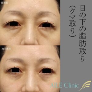 AILE clinicの目の下の脂肪取り（クマ取り）の症例3（施術前・施術直後）