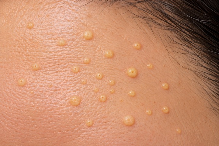 脂腺増殖症の臨床写真（額に多発した黄色い小丘疹。中心が点状に凹んでいるのが分かるもの）