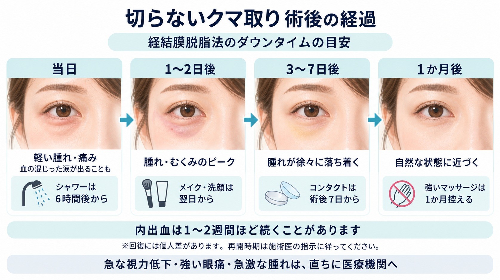 経結膜脱脂法の術後経過と、腫れ・内出血の目安、メイクやコンタクトレンズの再開時期、生活上の注意点を示す図